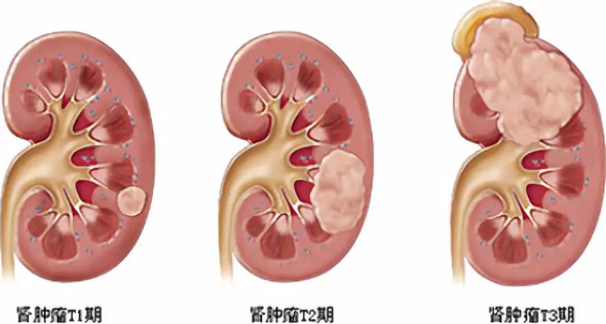 女性咽喉癌的早期癥狀圖片,關(guān)于女性咽喉癌的早期癥狀圖片及專業(yè)解答的問題,清晰計劃執(zhí)行輔導(dǎo)_冒險款33.14.39