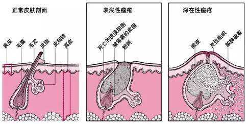 治療痤瘡的最好醫(yī)院,治療痤瘡的最好醫(yī)院，系統(tǒng)化分析與說明,科學解答解釋定義_進階版18.44.30